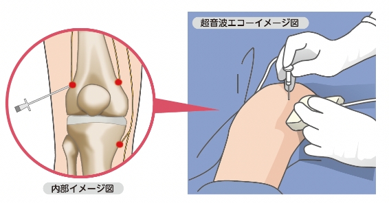 ラジオ波焼灼療法